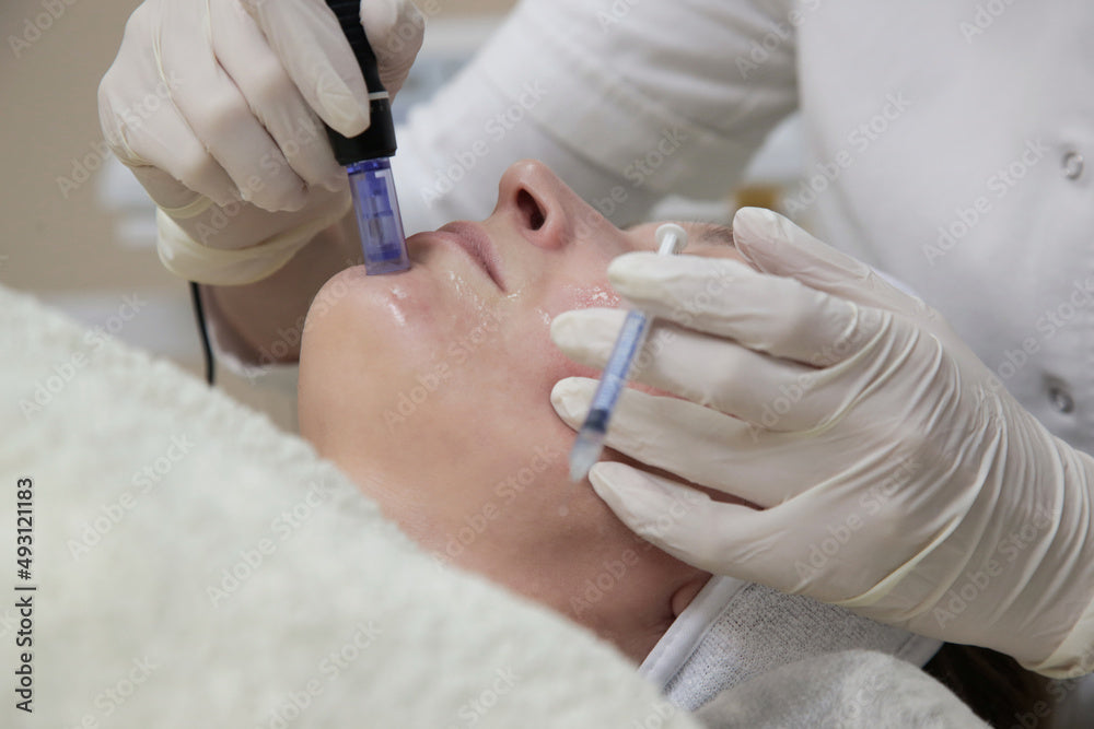 Revolutionize Your Skin with Microneedling and RF Machines