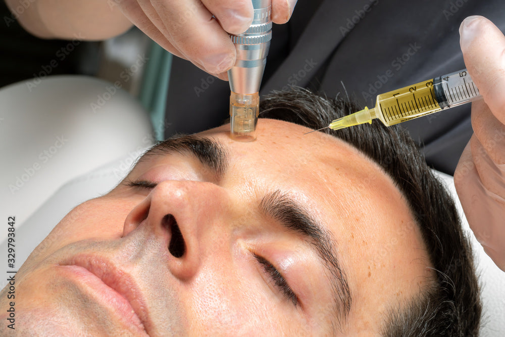 Maximizing Collagen Production: The Ultimate Guide to Microneedling Depth