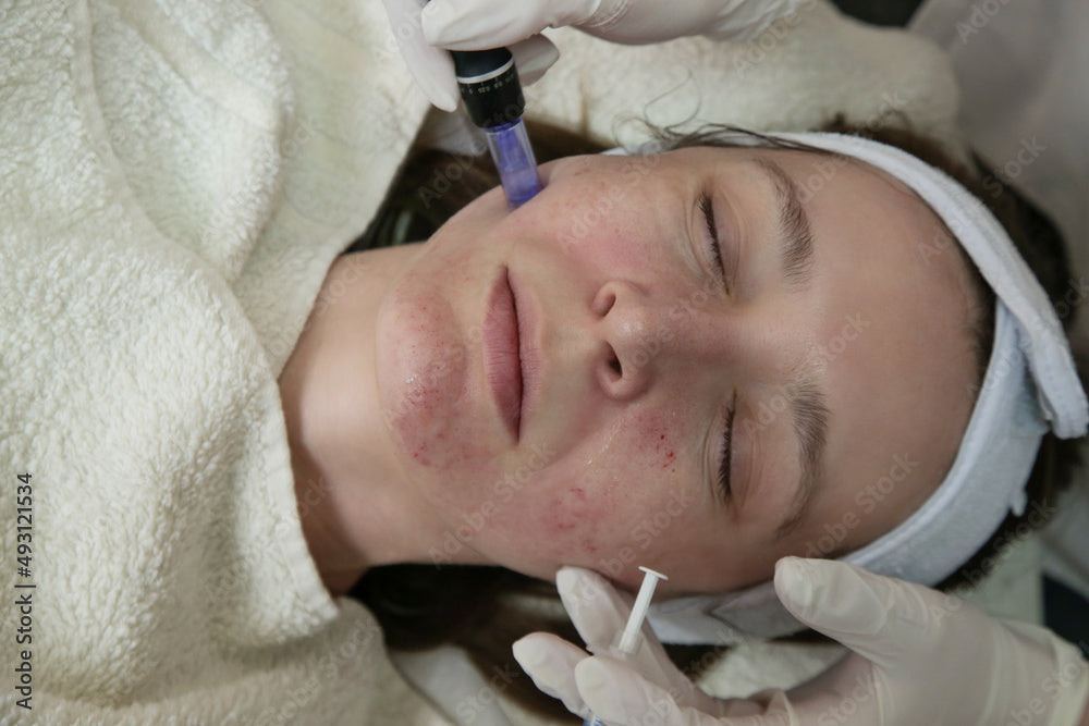 Collagen Induction Therapy: The Safest Option for Beautiful Skin