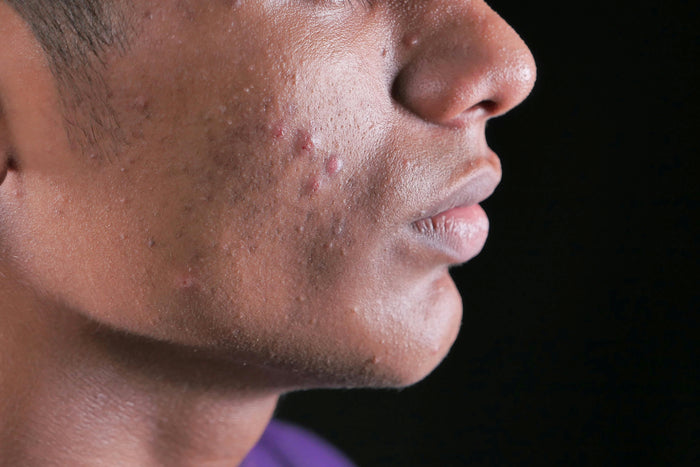 5 Essential Ways on How to Minimize Acne Scars